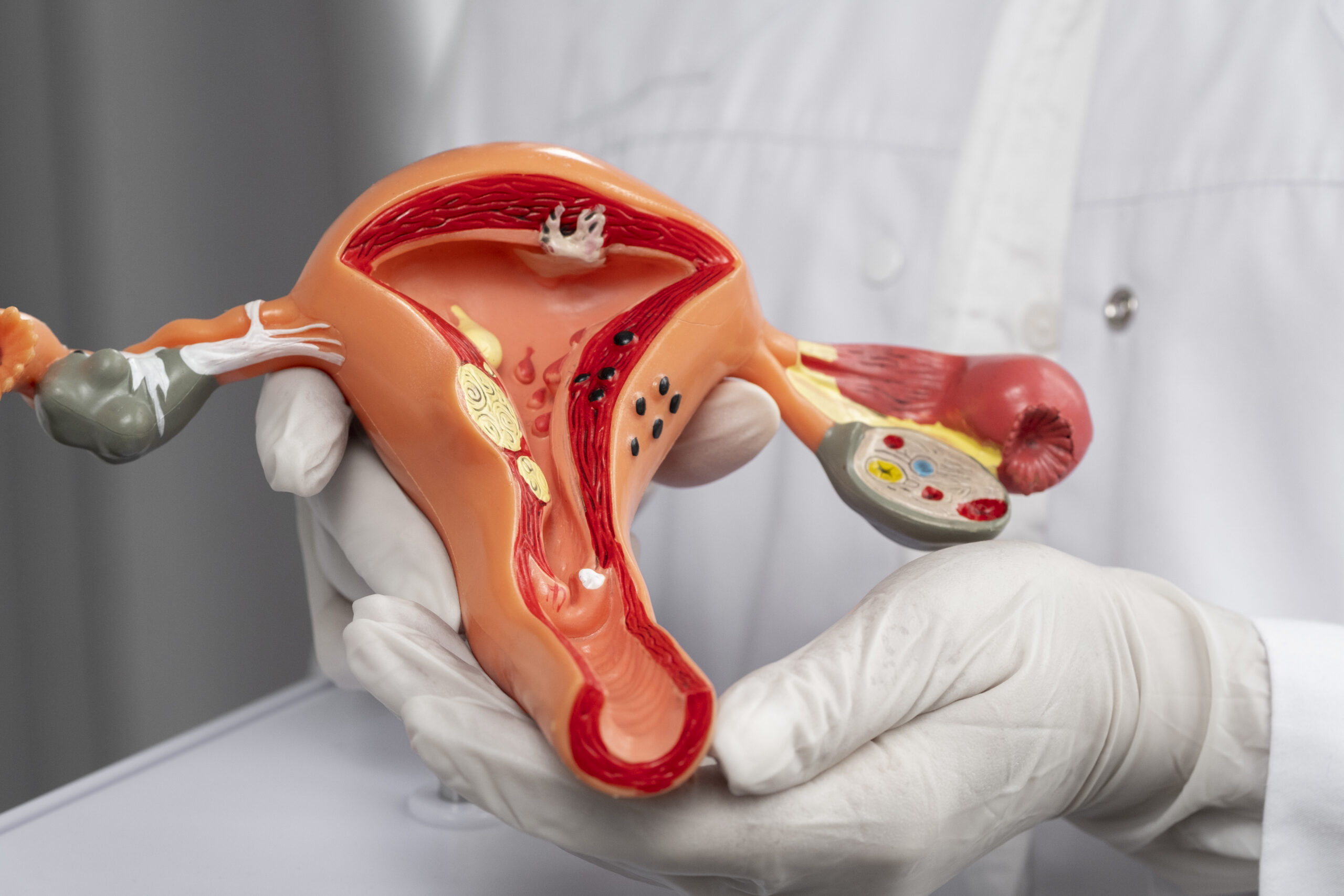 Ovarian diathermy in PCOS: An alternative